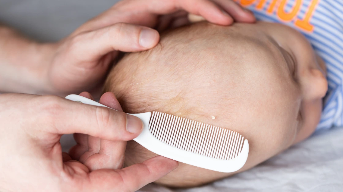 Baby Oil: A Gentle Touch for Your Little One's Skin Cradle Cap