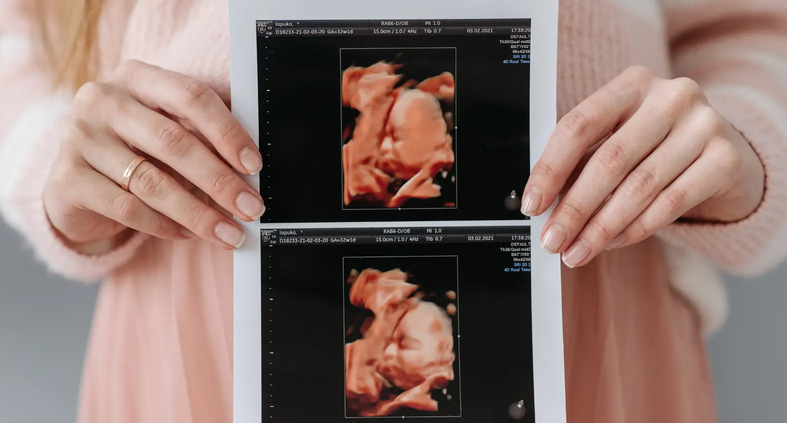 10 Weeks Pregnant 3D Ultrasound: What to Expect and Why It Matters Why Have a 3D Ultrasound at 10 Weeks