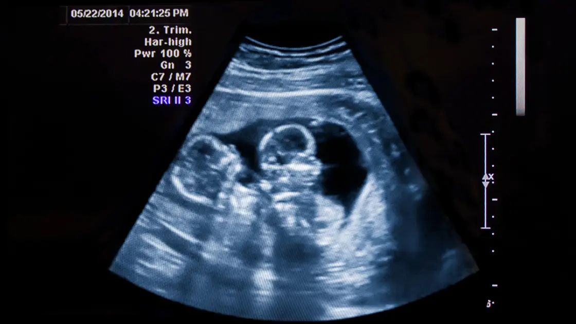 HCG Calculator: Track Twin Pregnancy Signs Like a Pro HGC and Twin Pregnancy