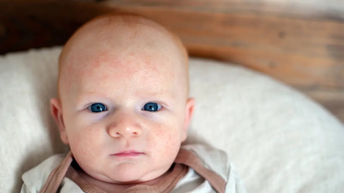 Can Allergies Cause Fever? Uncover the Hidden Danger How Allergies Impact Babies Differently Than Older Kids