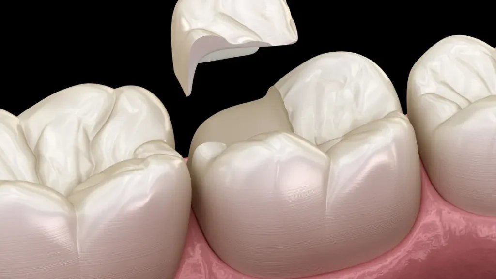 How to Fix a Chipped Tooth Naturally