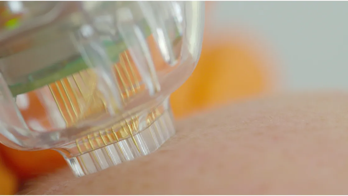 Proven Stretch Mark Removal: Powerful, Visible Results Microneedling for Stretch Mark Removal