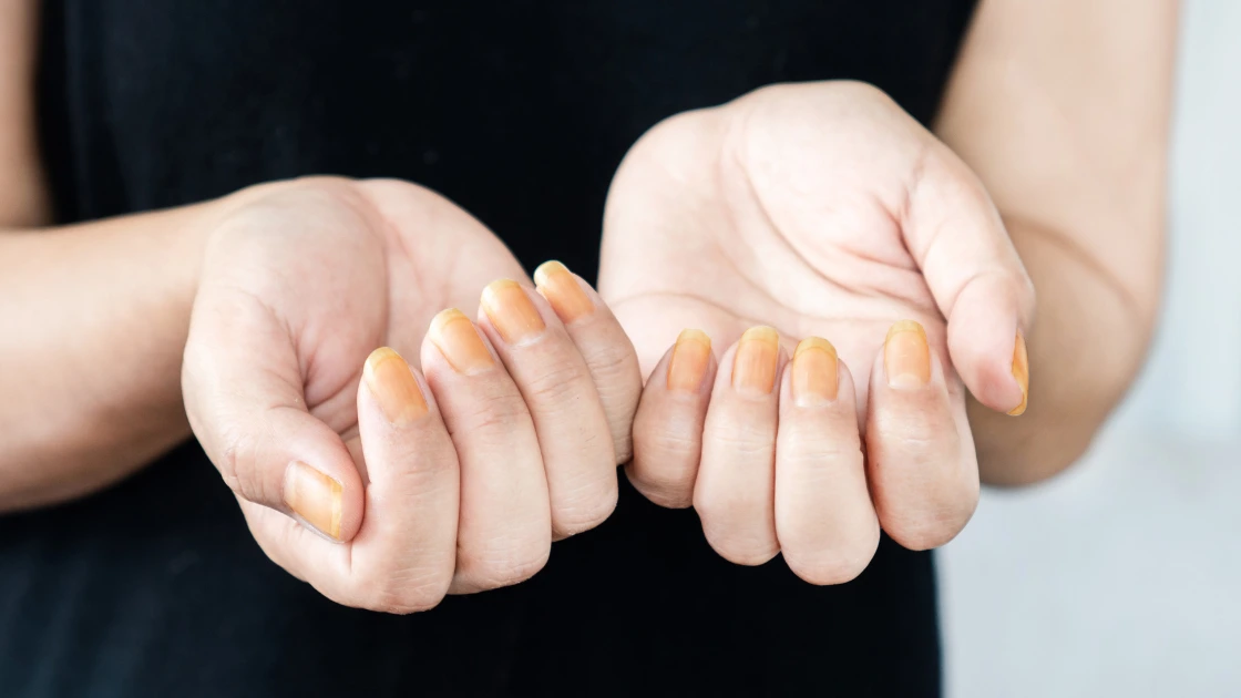 Pregnancy Nail Shapes: Healthy Nails with Stylish Care Nail Yellowing