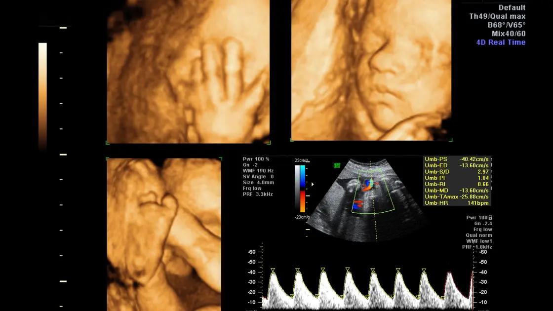 Posterior Placenta: A Critical Pregnancy Fact Decoded Posterior Placenta