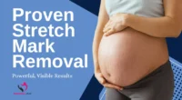 Proven Stretch Mark Removal