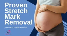 Proven Stretch Mark Removal