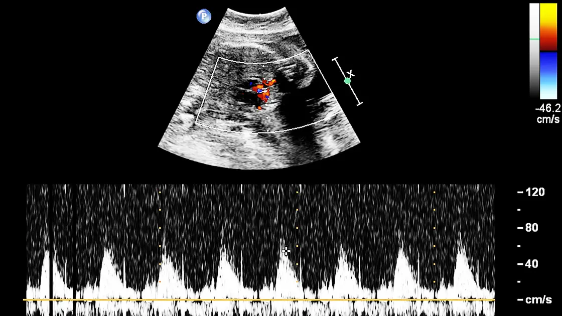 Intrauterine Pregnancy: Where New Life Takes Root Stages of Intrauterine Pregnancy
