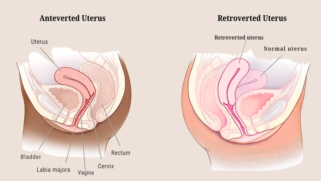 Anteverted Uterus: A Hidden Advantage in Fertility & Pregnancy anteverted vs retroverted uterus