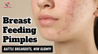 Breastfeeding Pimples