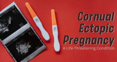 Cornual Ectopic Pregnancy