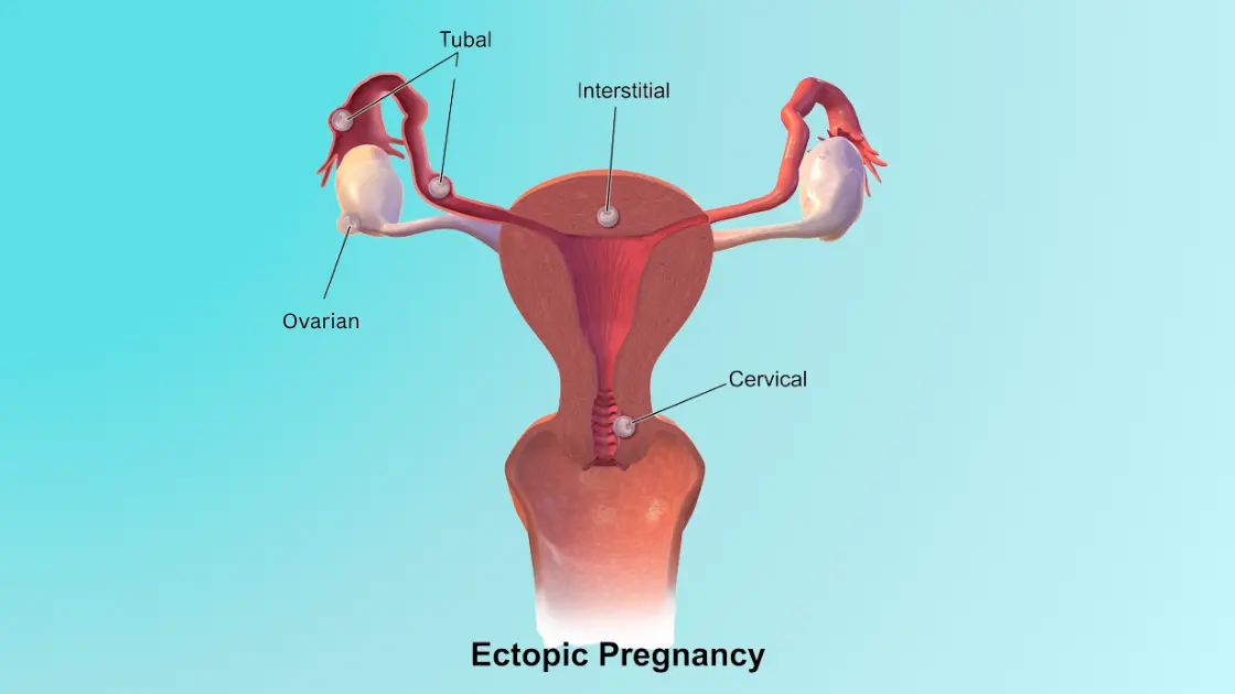 Cornual Ectopic Pregnancy
