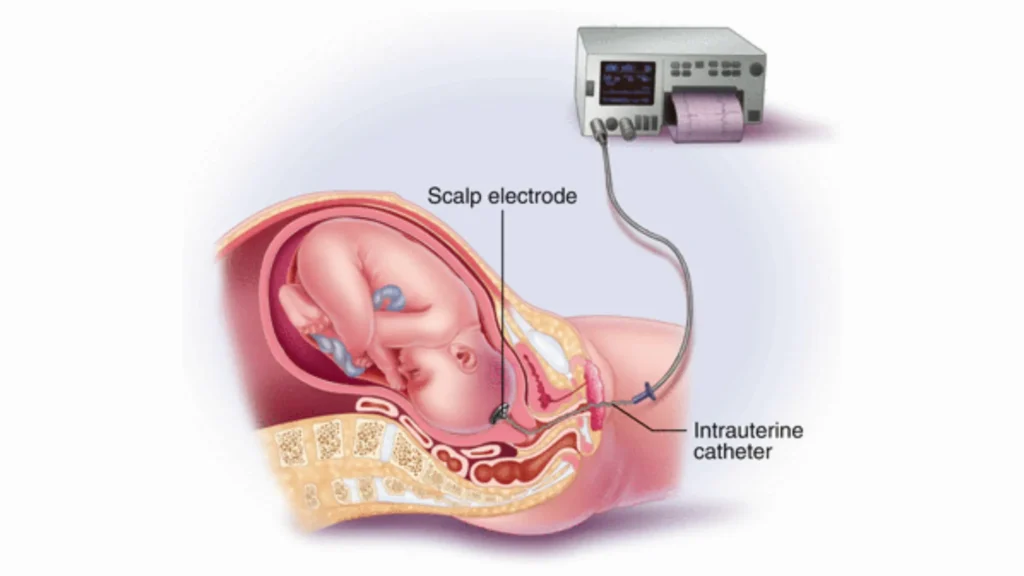Fetal Scalp Electrode: A Lifeline in Complicated Pregnancies fetal scalp electrode placement