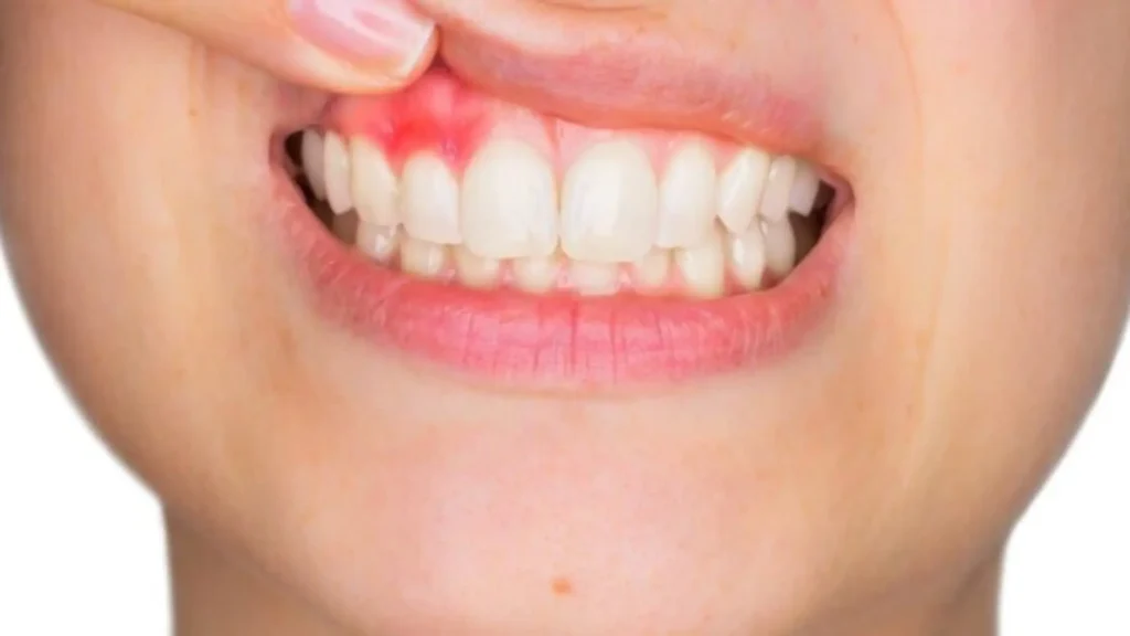 Amoxicillin for Tooth Infection: Don’t Let Pain Control You is amoxicillin good for tooth infection