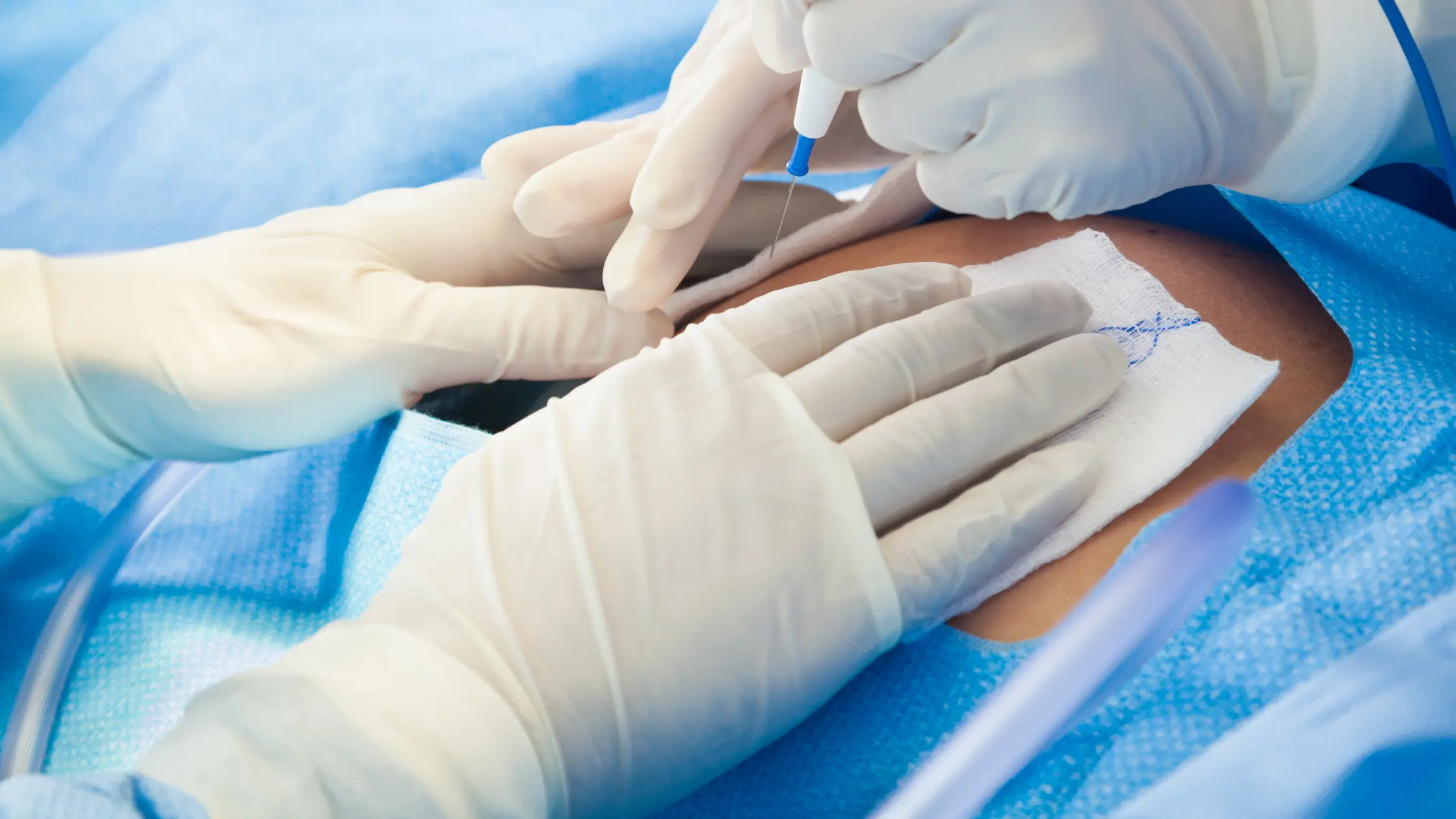 Signs of Internal Bleeding After C-Section