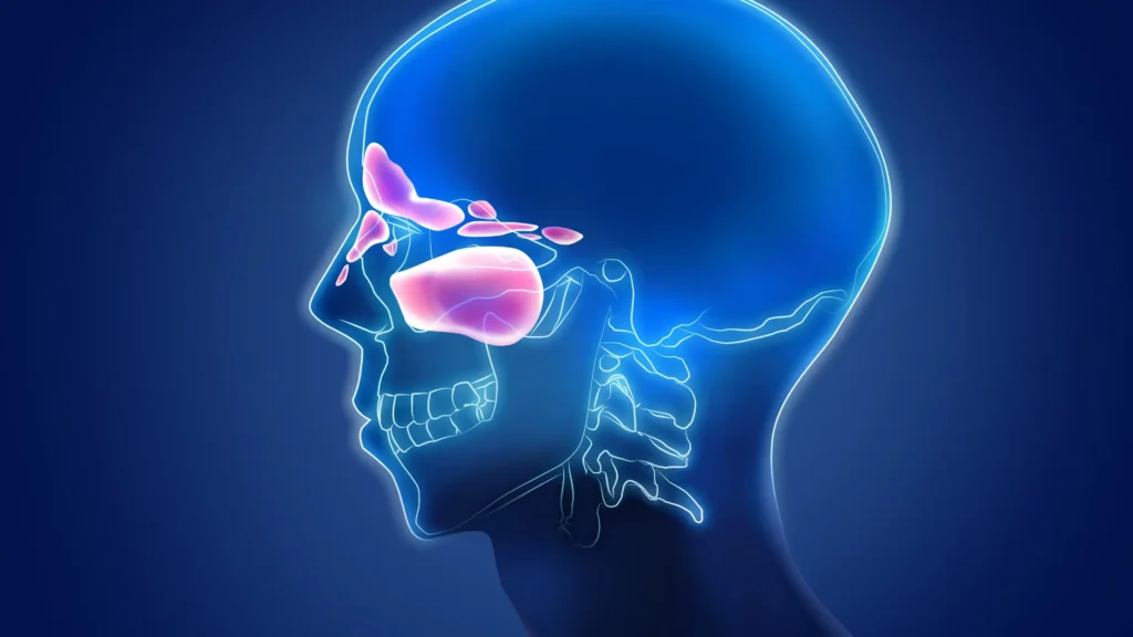 Tooth Infection Spread to Sinuses