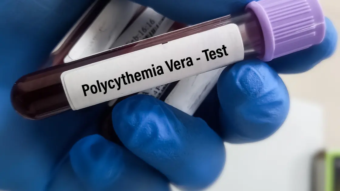 Polycythemia ICD 10 in Kids: Hope and Healing Ahead Polycythemia ICD 10