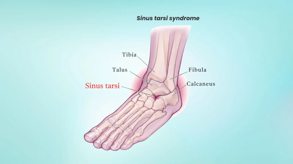 Sinus Tarsi Syndrome – 5 Signs Your Ankles Are at Risk What is Sinus Tarsi Syndrome