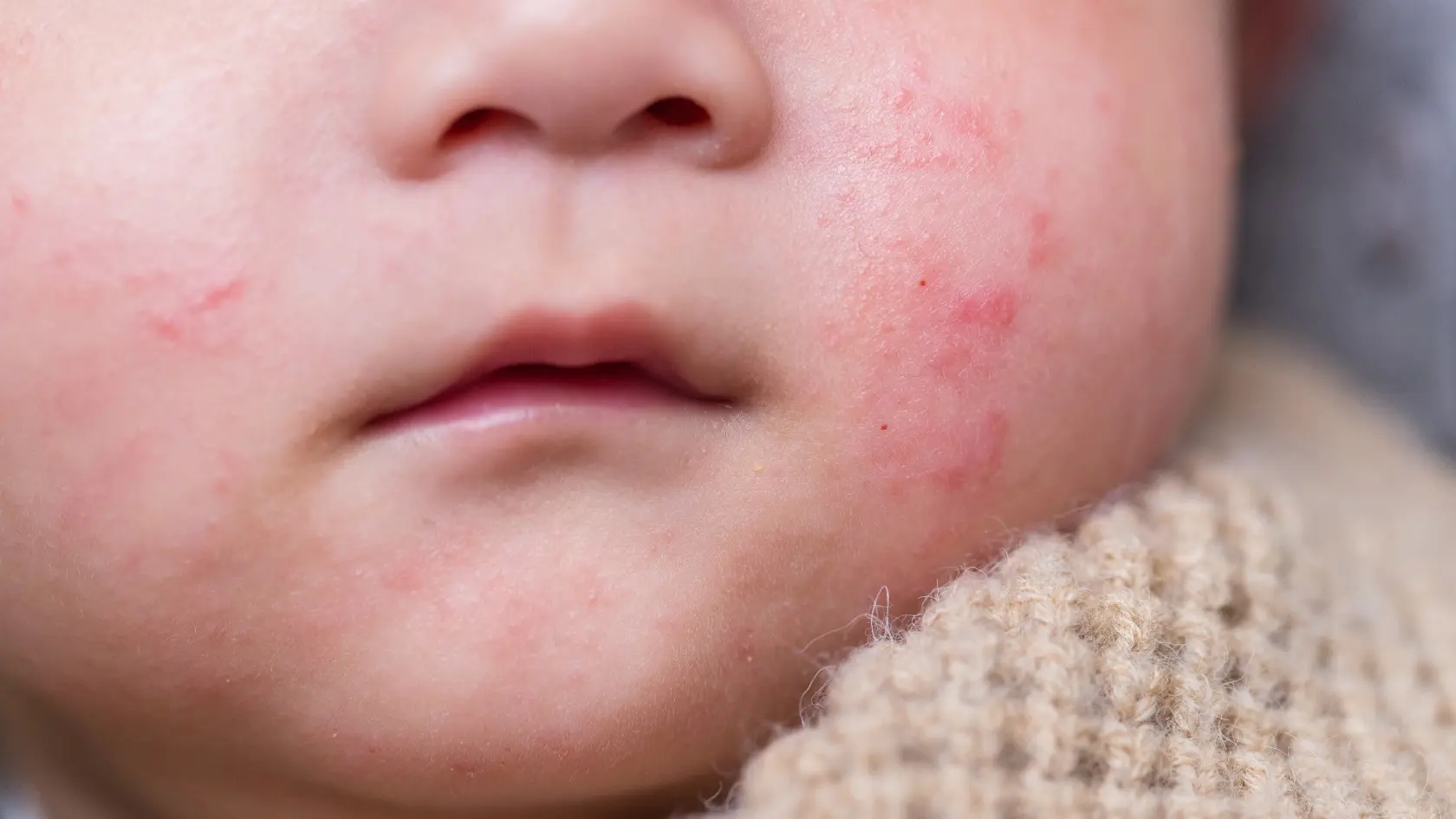 Baby Eczema