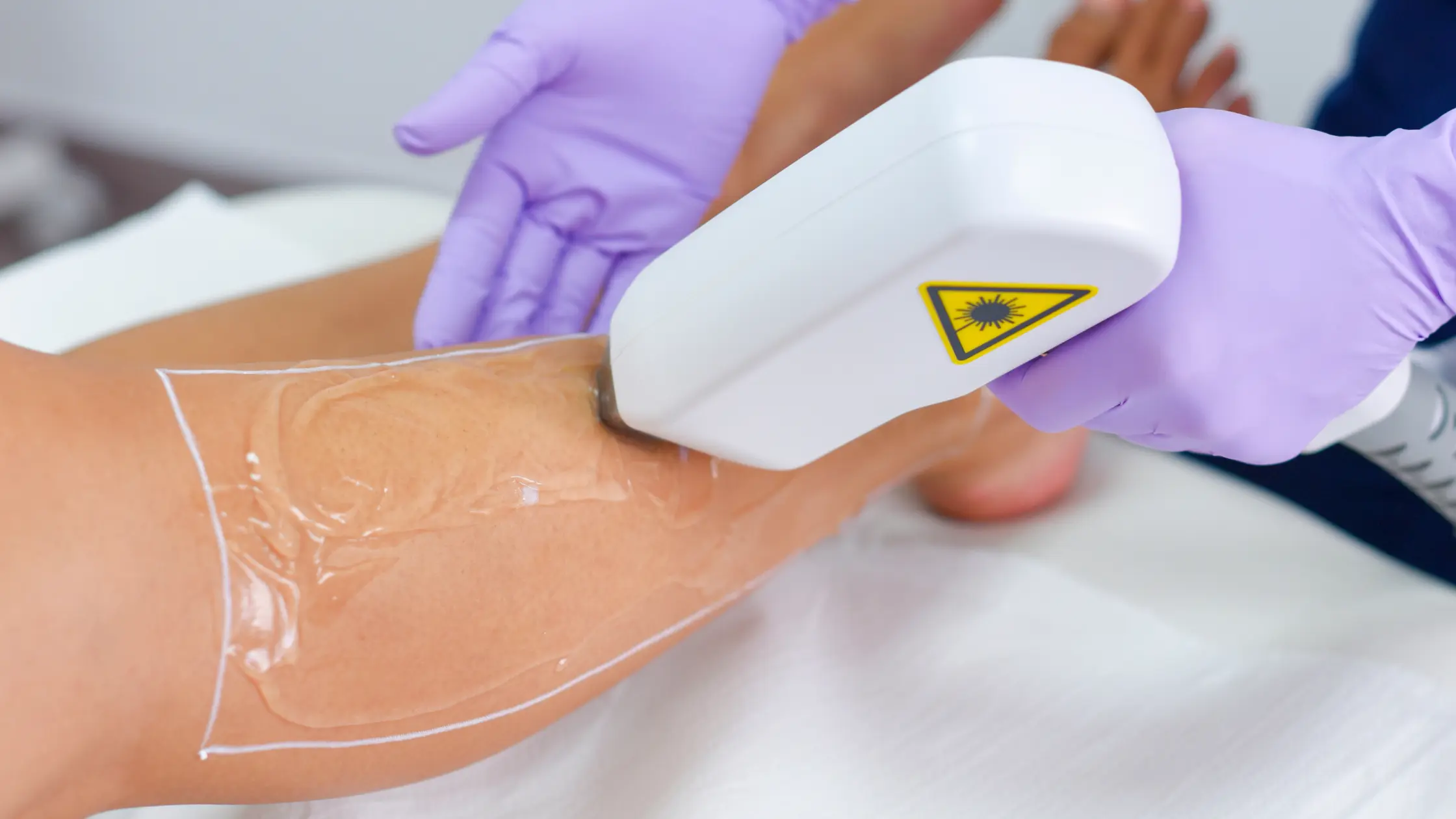 Can You Get Laser Hair Removal While Pregnant