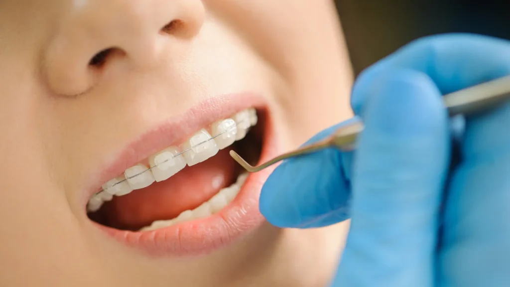 Braces for kids: Say Cheese with Extra Sparkle Ceramic Braces For Kids