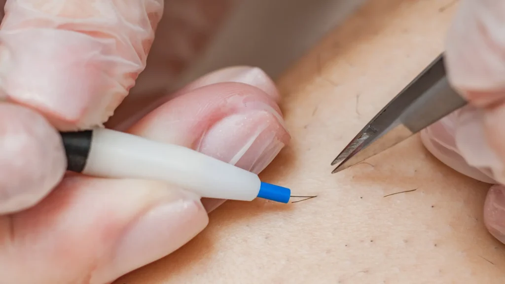 Electrolysis as Advanced Alternative of Laser Hair Removal During Pregnancy