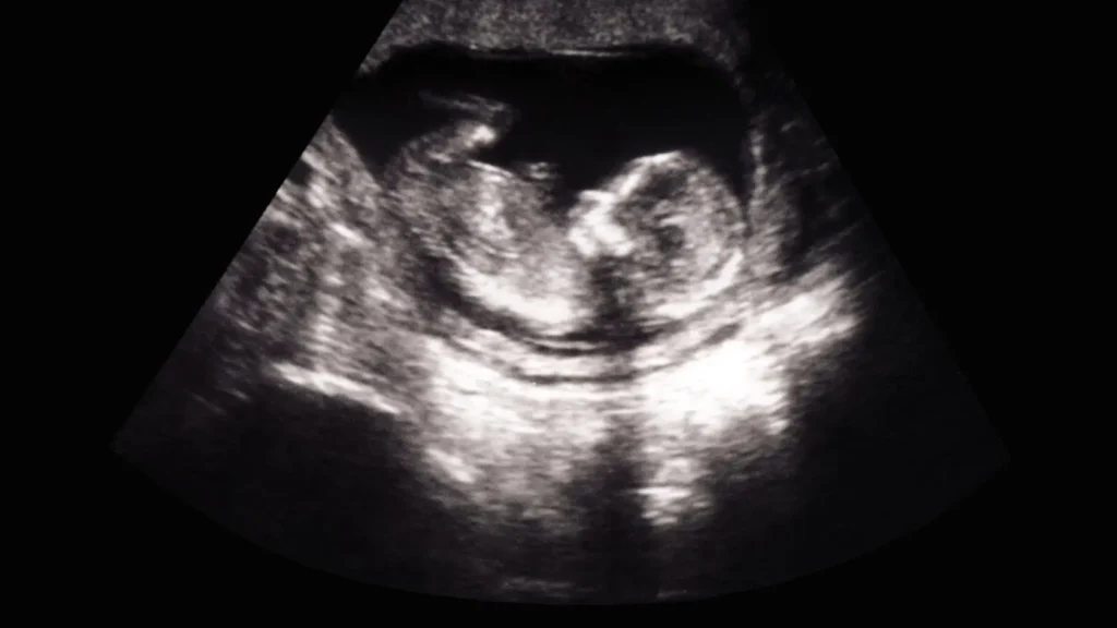 The Role of Ultrasound and Monitoring Tests