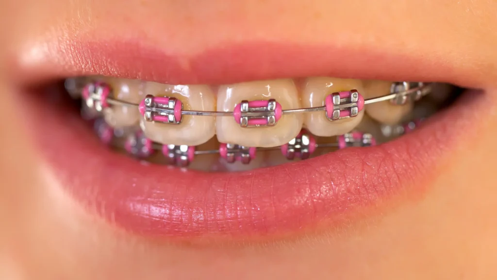 Braces for kids: Say Cheese with Extra Sparkle Traditional Metal Braces