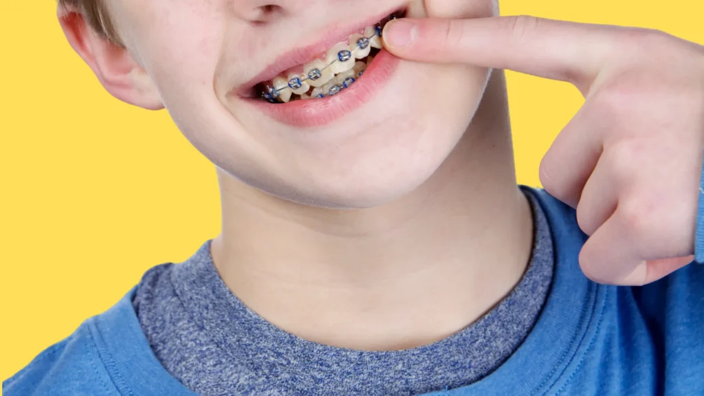 Braces for kids: Say Cheese with Extra Sparkle What Are Braces for Kids