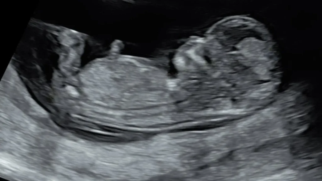 Exomphalos Ultrasound Diagnosis